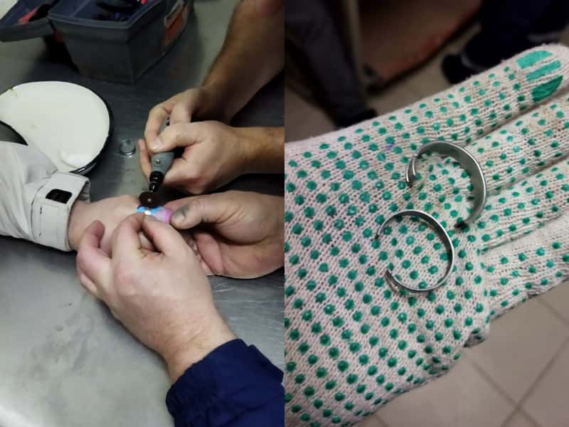 Пришлось распилить — молодой уралец не сумел самостоятельно снять кольцо 