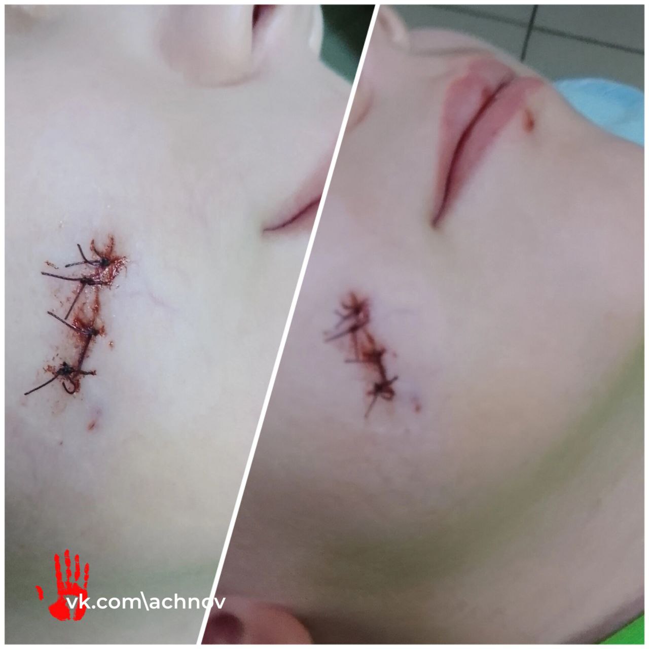 На Урале второкласснику разорвало щеку в школьном туалете