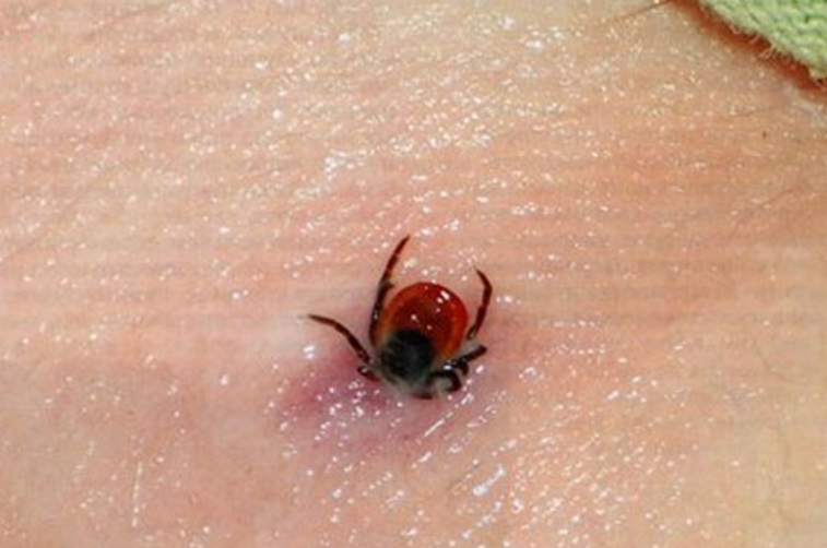 Клещи успели покусать 303 свердловчанина Клещи успели покусать 303 свердловчанина