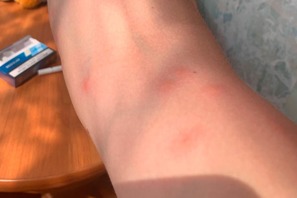 Отдыхающие пожаловались на сыпь после купания в Тургояке