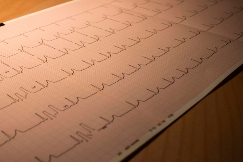 Сосудистый хирург назвал основные признаки атеросклероза  | Врач Некрасов раскрыл главные симптомы атеросклероза