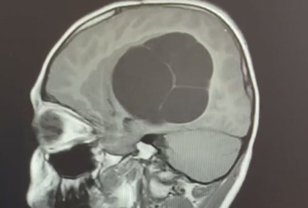 В Челябинске у 12-летнего мальчика из головы извлекли кисту, в которой поселились личинки паразита