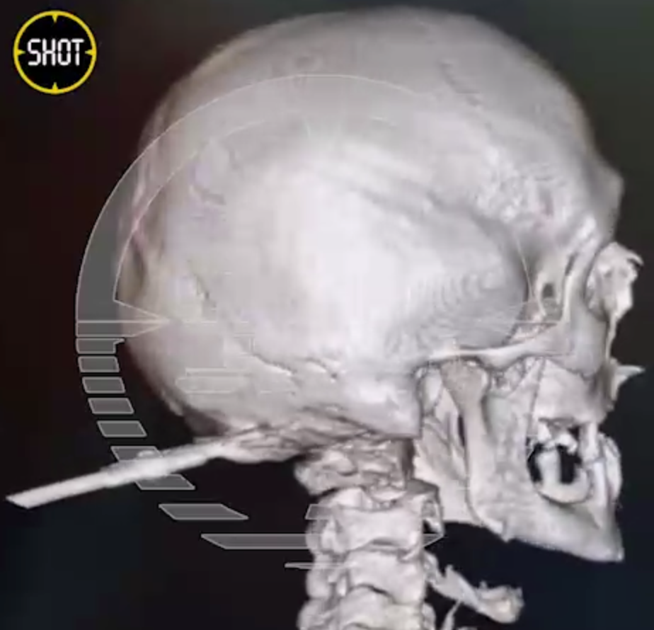 Отвёртку в голову воткнули мужчине из Башкирии | Отвёртку в голову воткнули мужчине из Башкирии